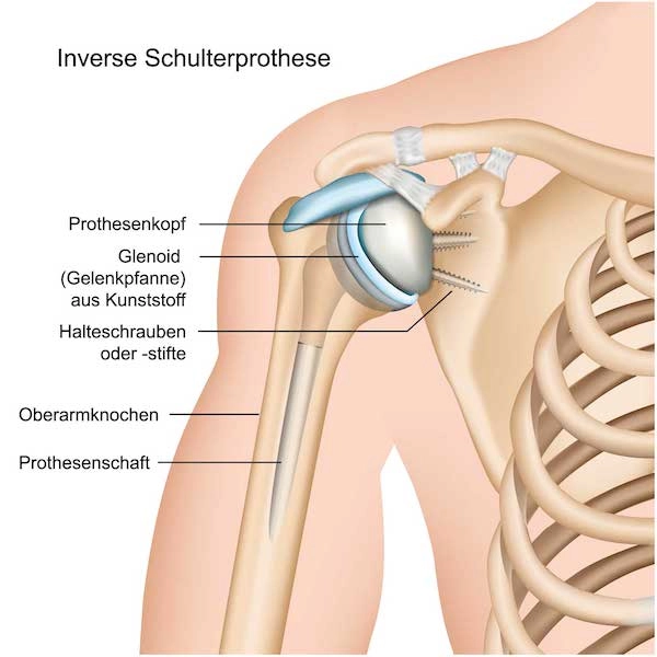 Inverse-Schulterprothese