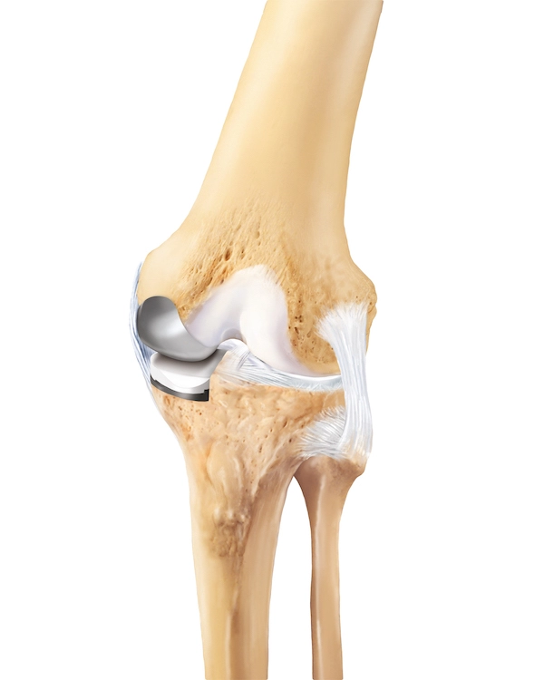 Knie Schlittenprothese - Das halbe künstliche Kniegelenk